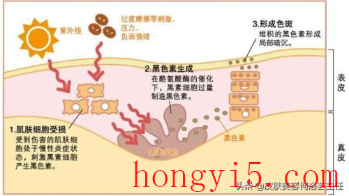 面部七种斑的图片(肝斑长在脸上哪个部位)插图3