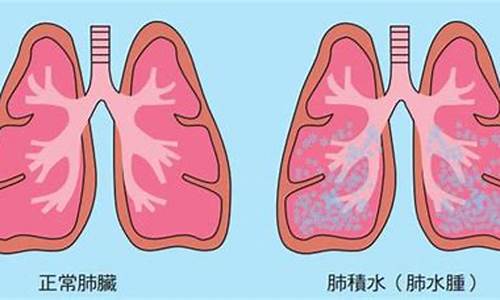 肺积水是怎么引起的(婴儿肺积水是怎么引